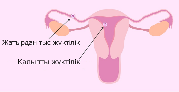 Жатырдан тыс жүктілік